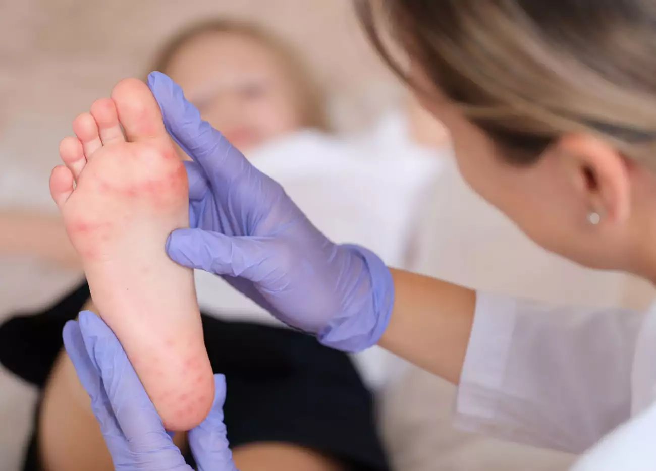 Αυξάνονται τα περιστατικά κοξάκι στα παιδιά