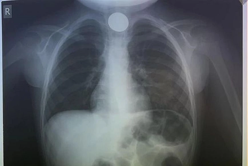 Στο νοσοκομείο κατέληξε ένας 4χρονος που κατάπιε κέρμα