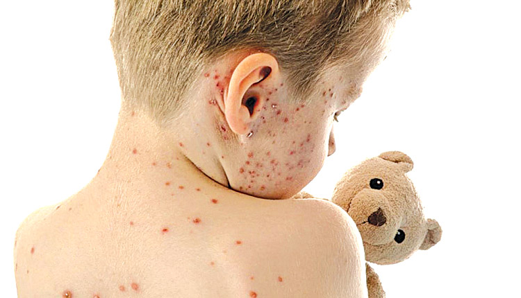 Φόβοι για επιδημία ιλαράς στην Ελλάδα