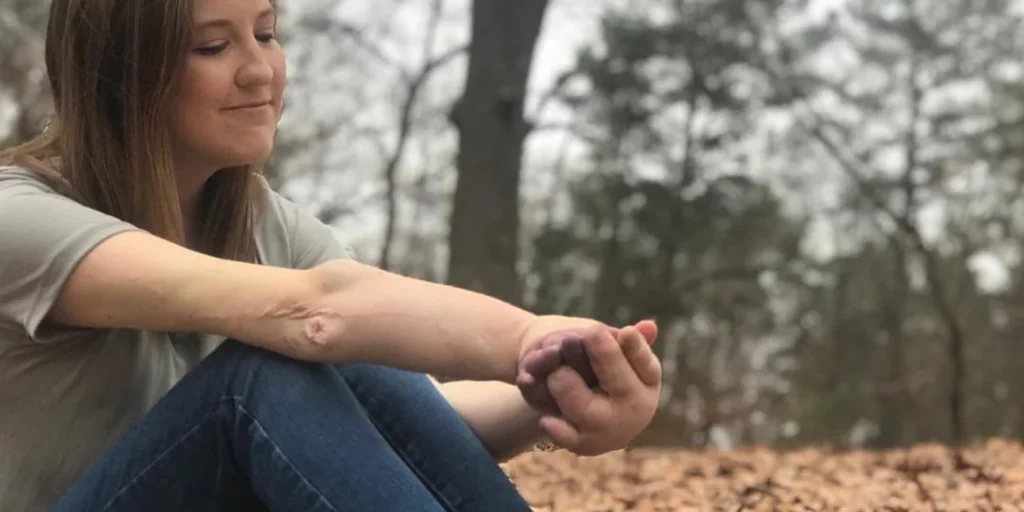 Γυναίκα που γεννήθηκε με πρησμένα χέρια παλεύει για τα απλά