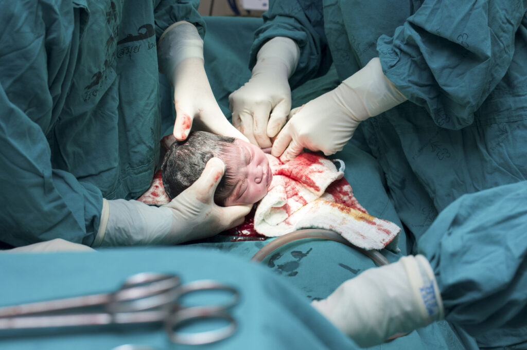 Ανοδικές τάσεις για τις αναίτιες καισαρικές στη χώρα