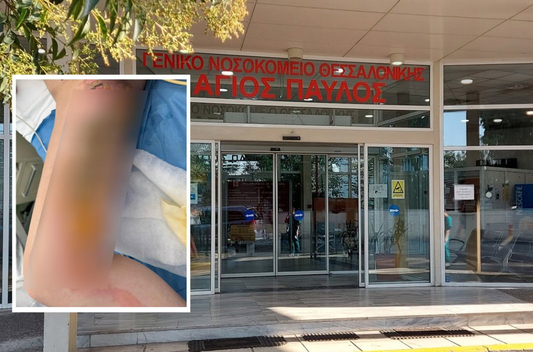 Εφιάλτης για 20χρονη στη Θεσσαλονίκη: Μπήκε στο νοσοκομείο για αφαίρεση κύστης κόκκυγα και…