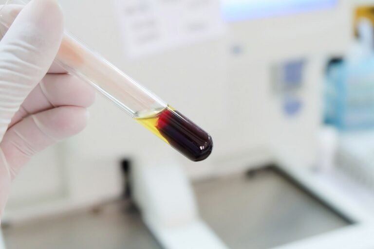 Τι είναι και πότε εφαρμόζεται η πλασμαφαίρεση – Τι λένε οι ειδικοί
